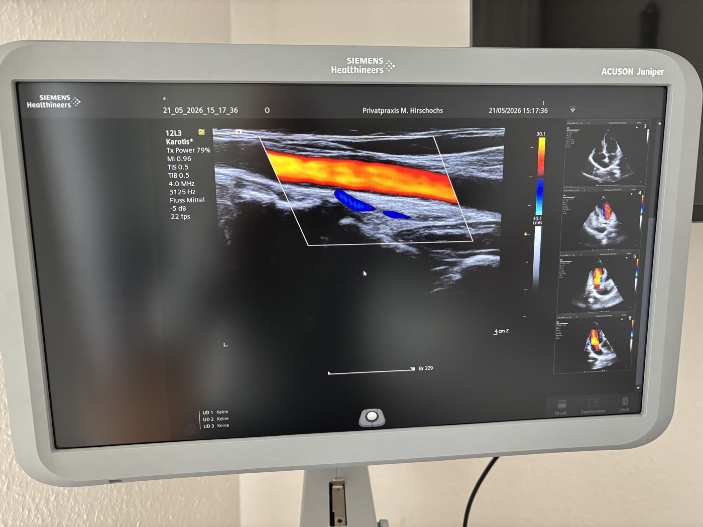 Ultraschallgerät mit Aufnahme der Halsschlagader im Farbdoppler